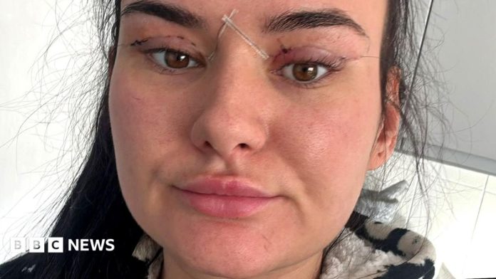 Open wounds and eyes that can’t close – women warn about cheap bleph eyelid surgery