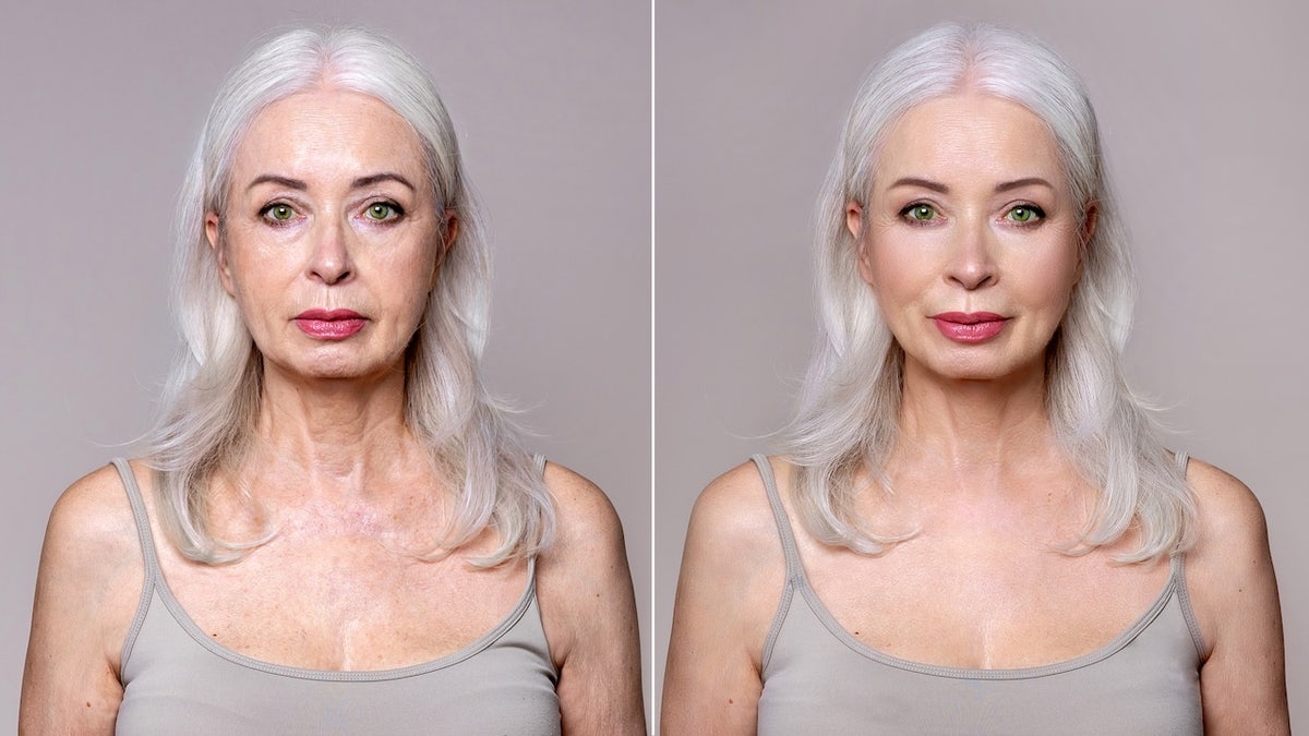 Before and after facelift