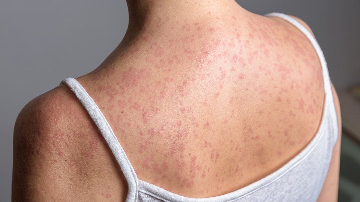 Woman with red, spotty rash on upper back and shoulders.